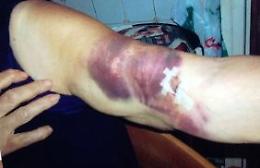 Azzannata dal pitbull: immagini shock