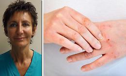 «Dermatiti in agguato se si esagera con il gel» 