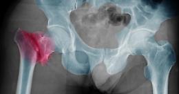 Osteoporosi, malattia silenziosa che colpisce le ossa
